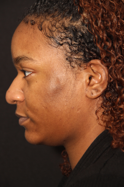 Cosmetic Surgery Lip Lift Before
