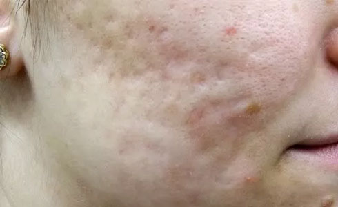 Acne scars 2