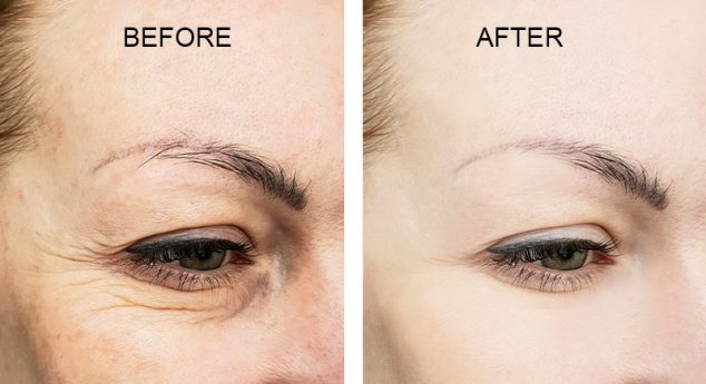 What You Need To Know Before Your Botox Treatment