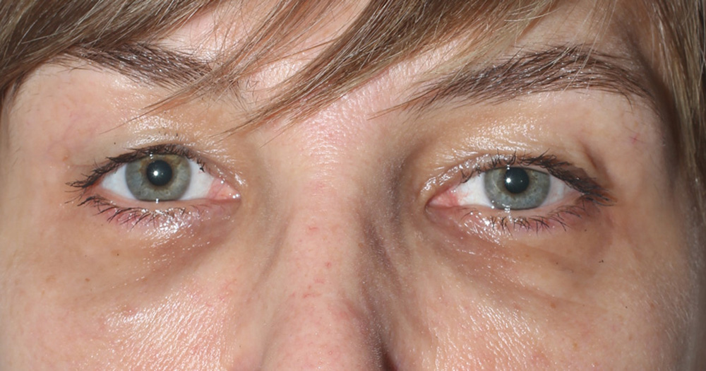 Blepharoplasty Before and After Photos