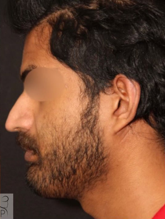 Chin Implant Before After Photos