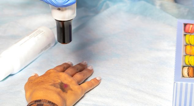 MicroLaser Peel using Lite Erbium