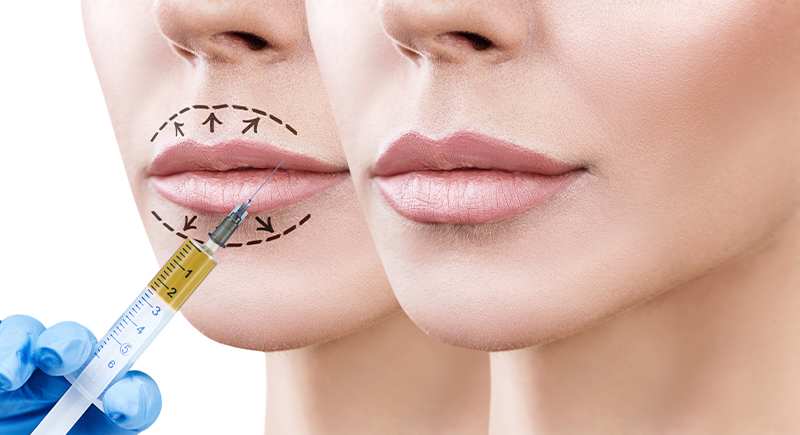 Permanent Facial Fillers Bellafill