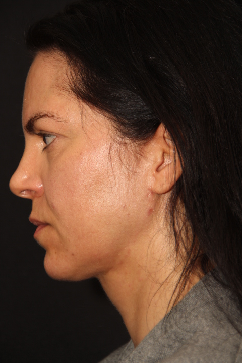 Neck Liposuction Before & After