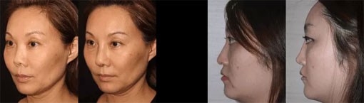 Asian Rhinoplasty Before and After