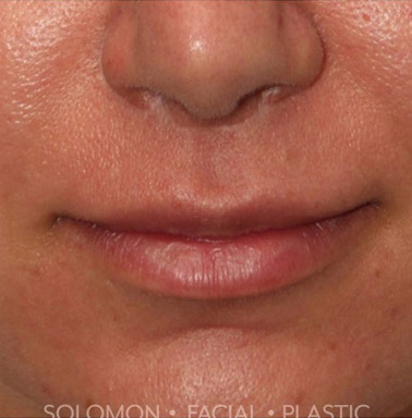 Lip Lift Before After Photos