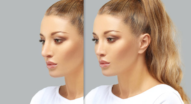 REVISION-RHINOPLASTY