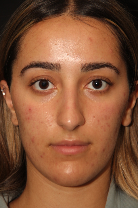 Before Rhinoplasty Surgery Patient 302 5