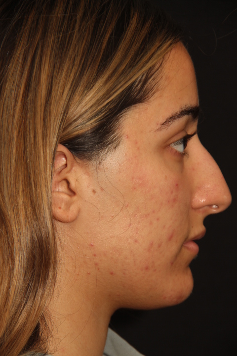 Before Rhinoplasty Surgery Patient 302 2