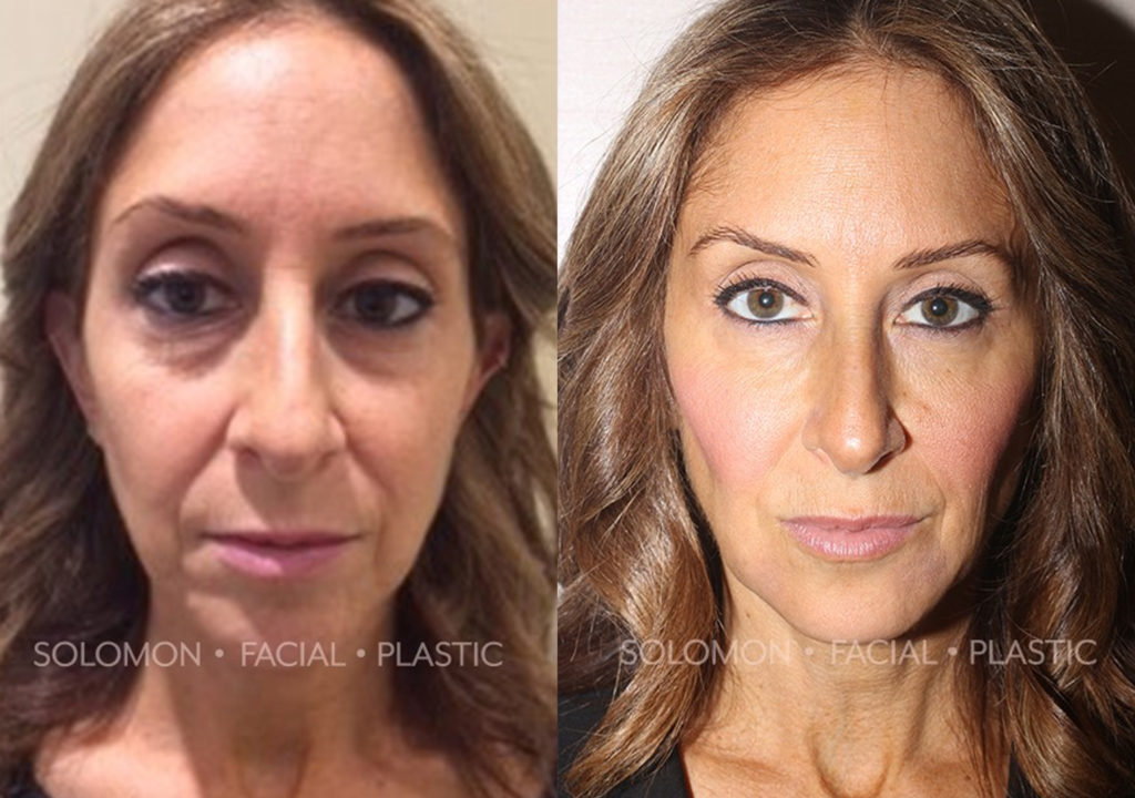 Botox before and after Toronto 1