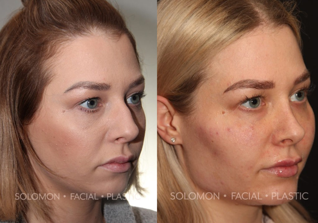 Botox before and after Toronto 2