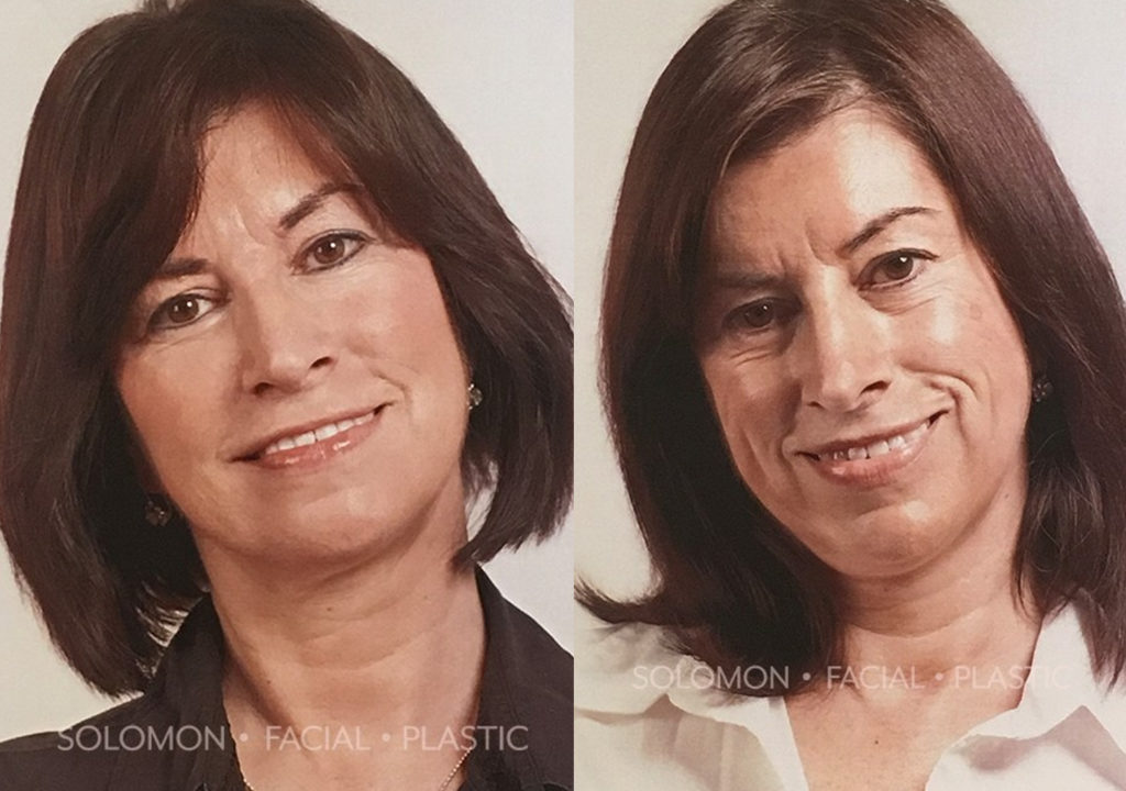 Botox before and after Toronto 3