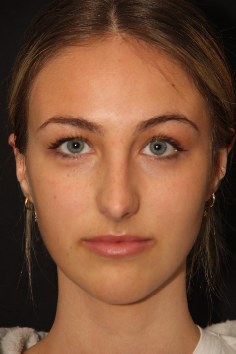 Before Rhinoplasty Surgery Patient 301 5