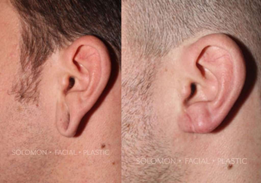 Earlobe Repair before and after Toronto 1