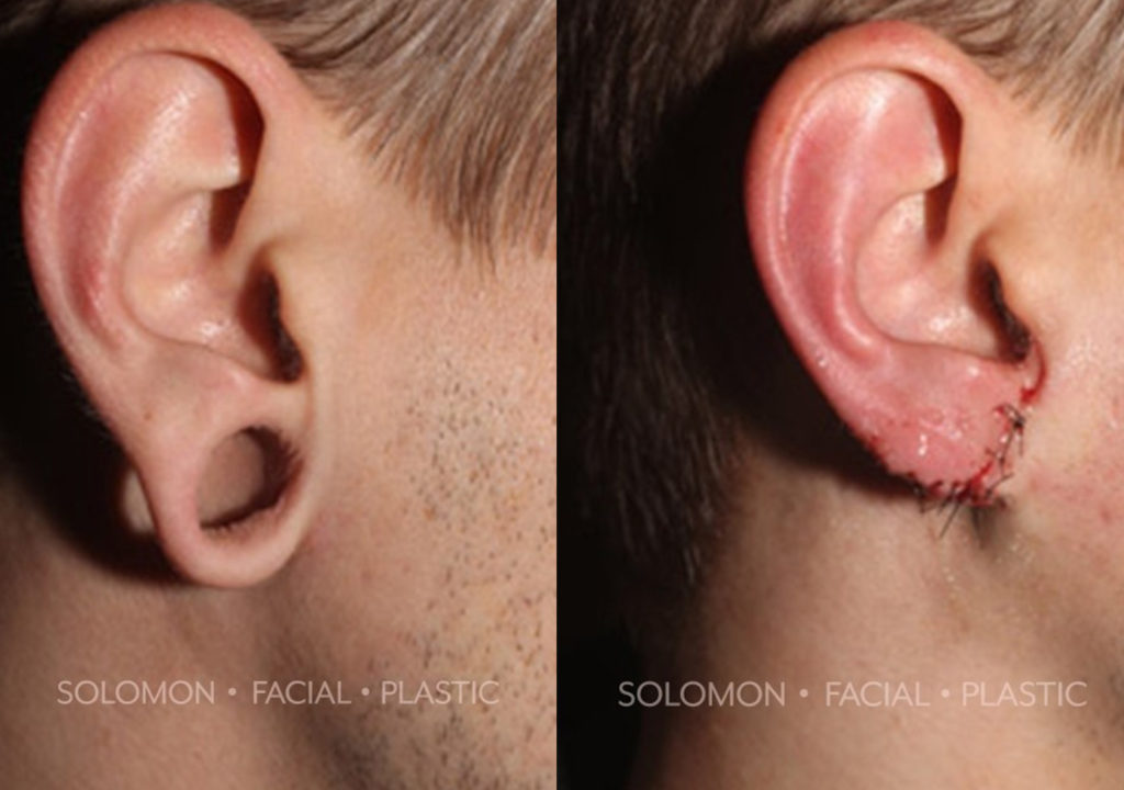 Earlobe Repair before and after Toronto 2
