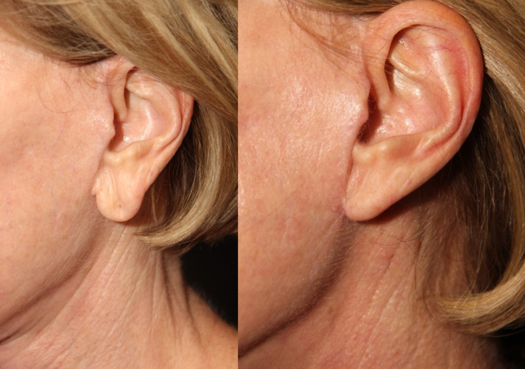 Earlobe Repair before and after Toronto 3