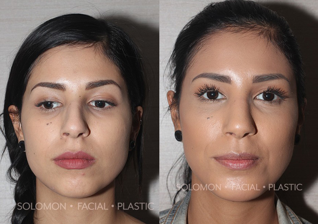 Facial Implants before and after Toronto