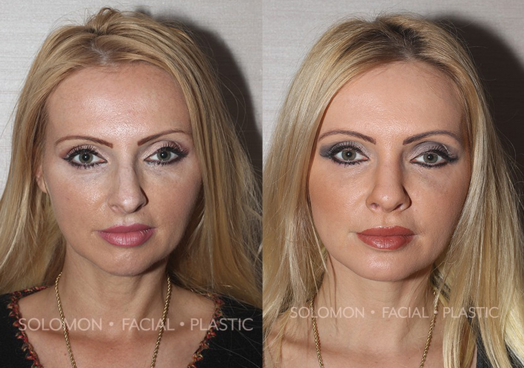 Facial Implants before and after Toronto 2