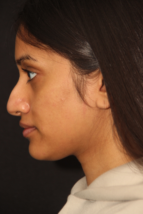 Before Rhinoplasty Surgery Patient 300 6