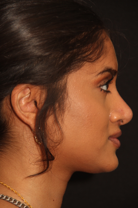Aftere Rhinoplasty Surgery Patient 300 3