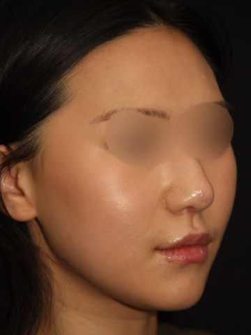 After Non Caucasian Rhinoplasty Surgery Patient 25 2