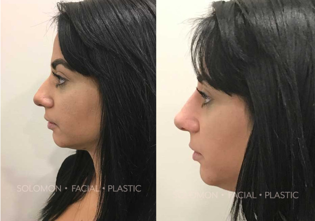 Injection Rhinoplasty before and after Toronto 1