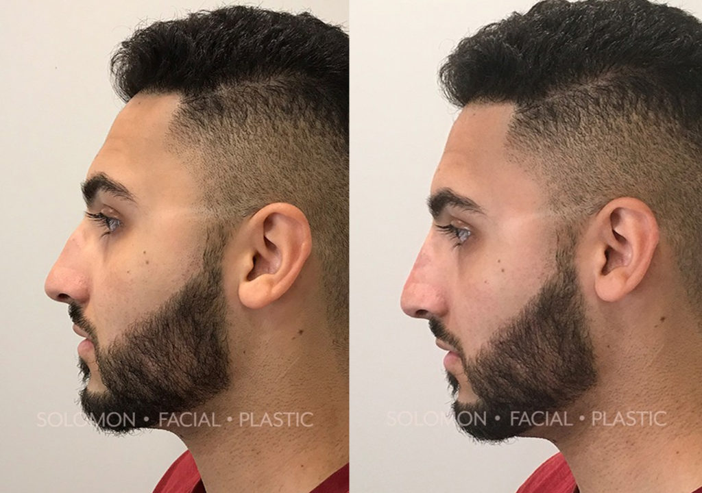 Injection Rhinoplasty before and after Toronto 3