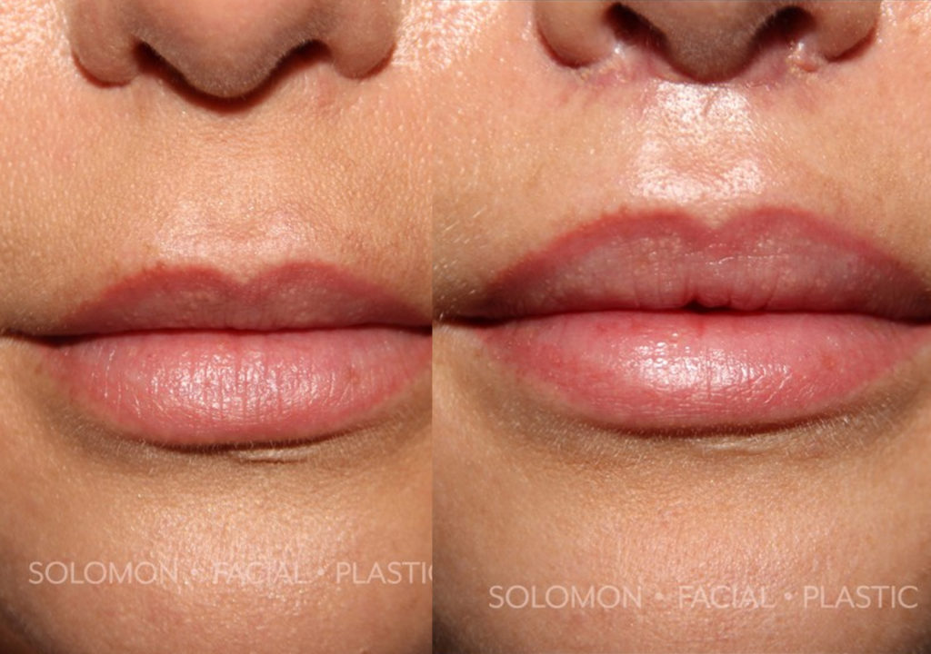 Lip Lift before and after Toronto 1