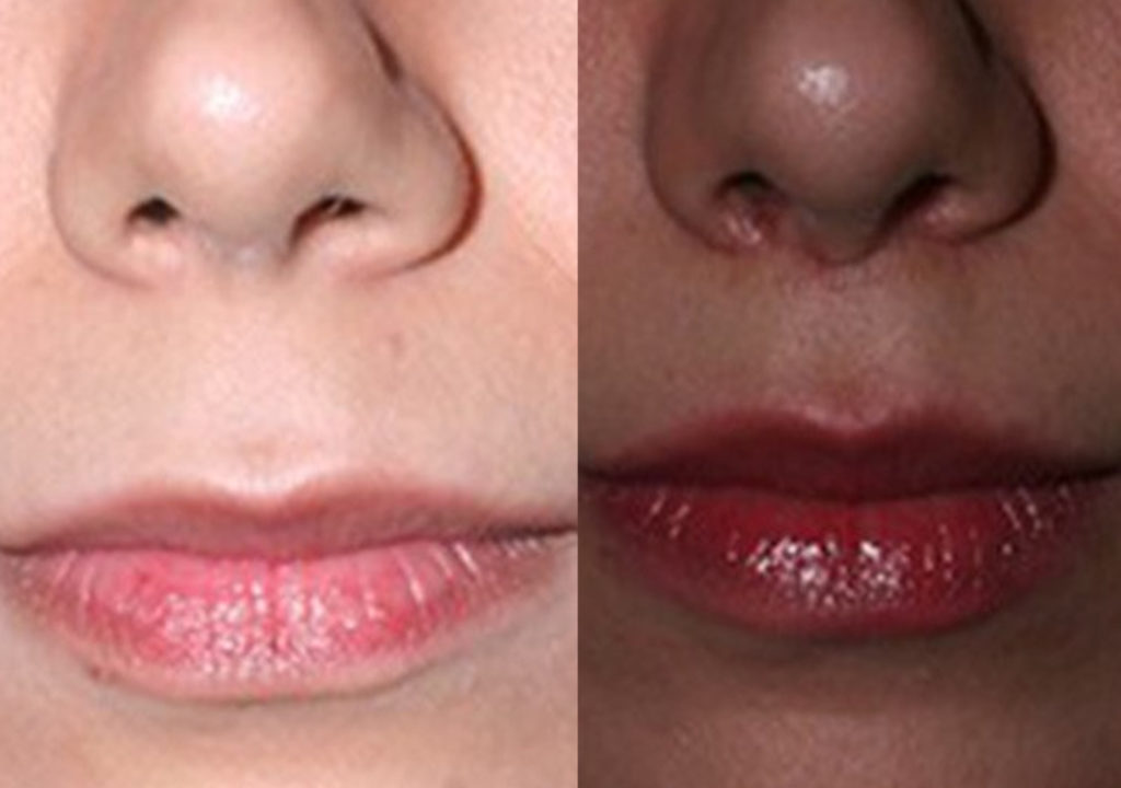 Lip Lift before and after Toronto 2