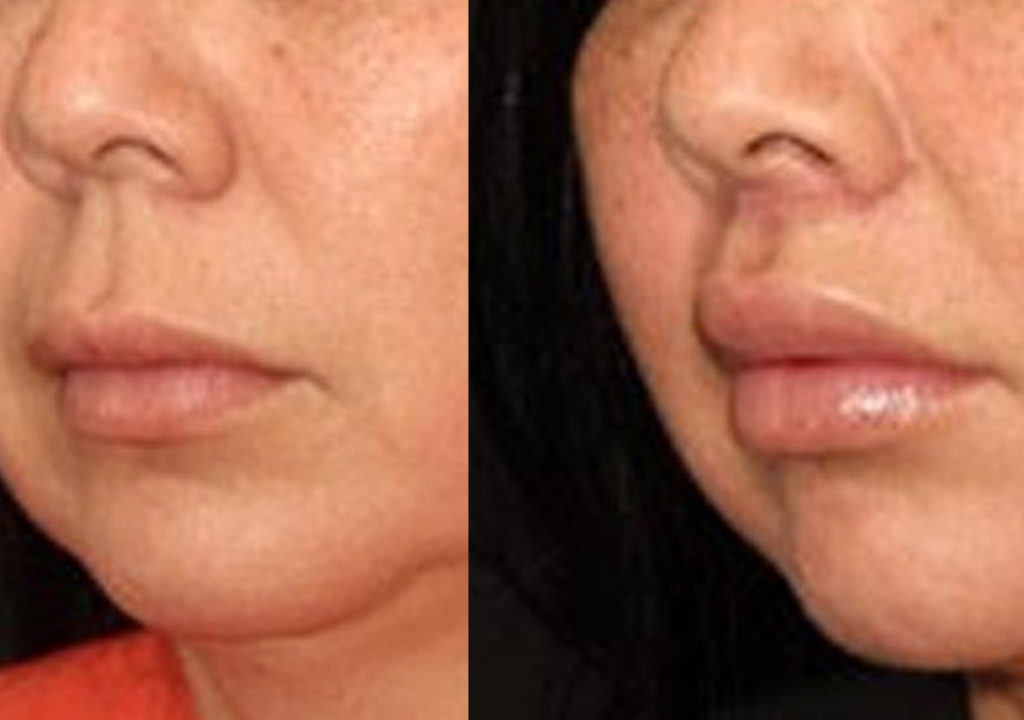 Lip Lift before and after Toronto 3