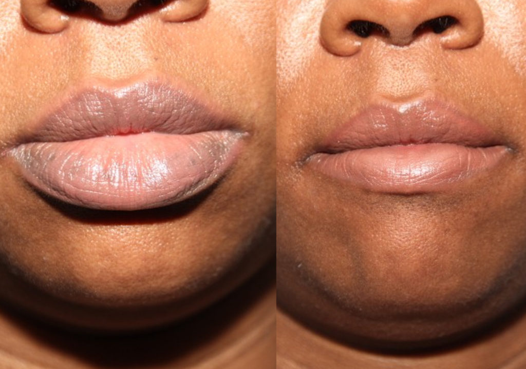 Lip Reduction before and after Toronto 1