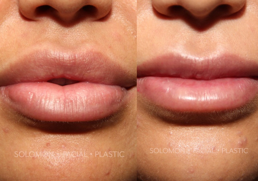 Lip Reduction before and after Toronto 2