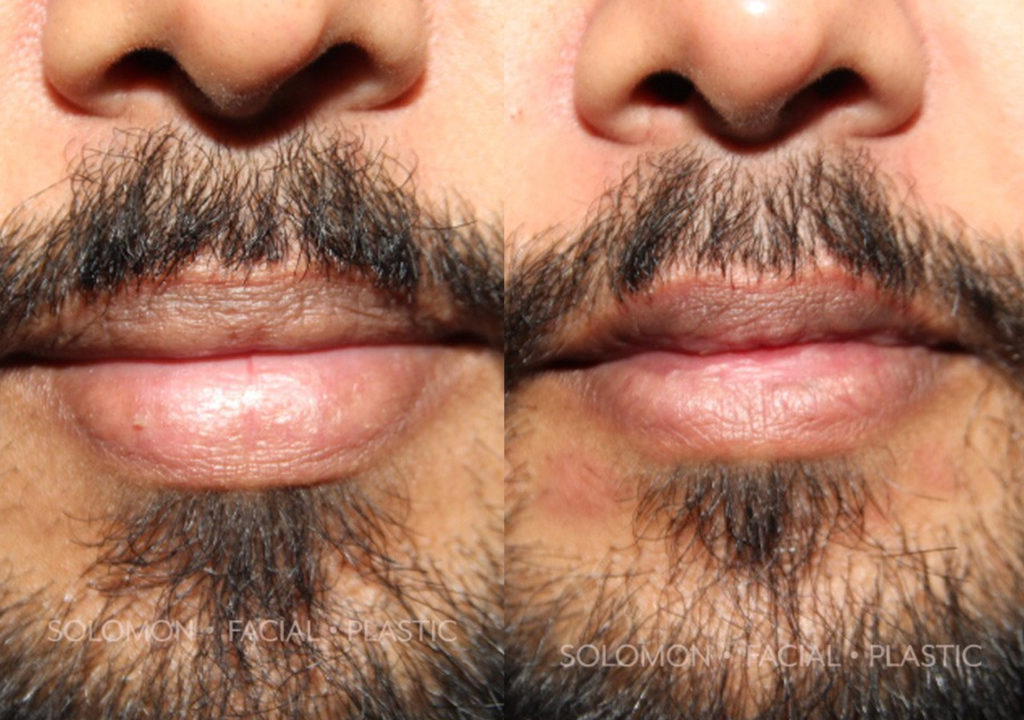 Lip Reduction before and after Toronto 3