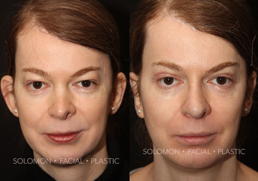 Otoplasty before and after Toronto 2