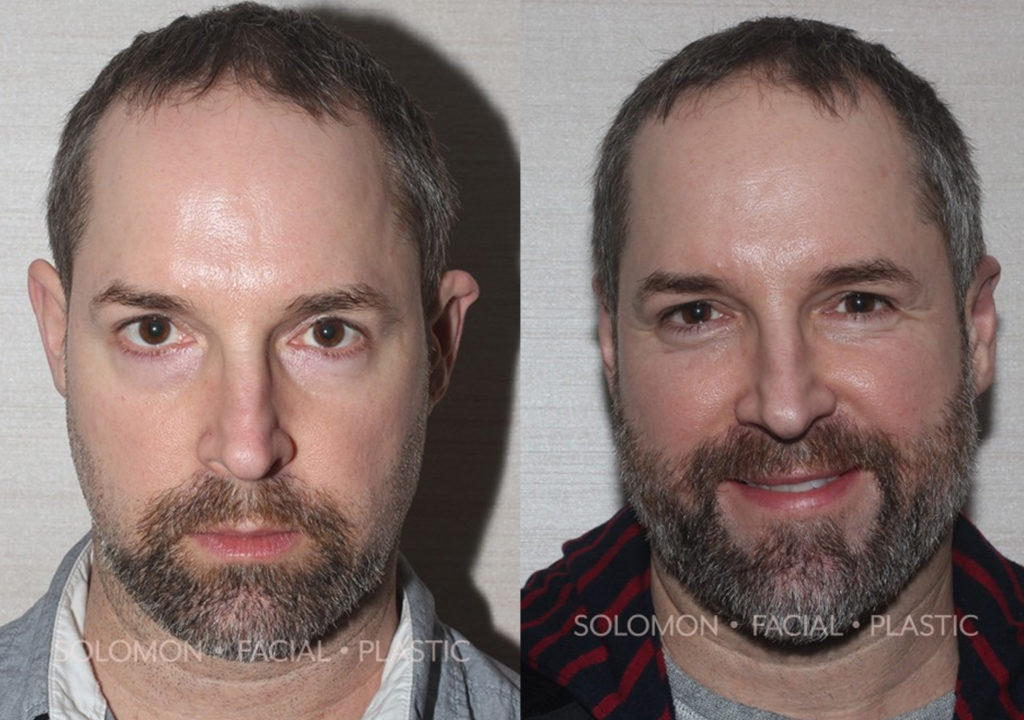Otoplasty before and after Toronto 3