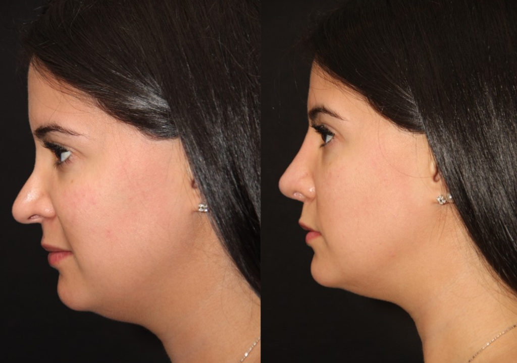 Revision rhinoplasty before and after