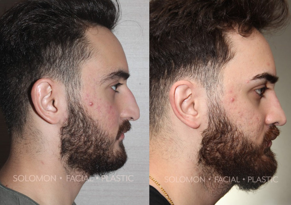 Secondary rhinoplasty before and after