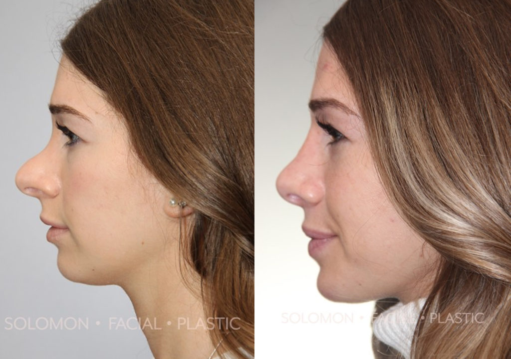 Before and after revision rhinoplasty