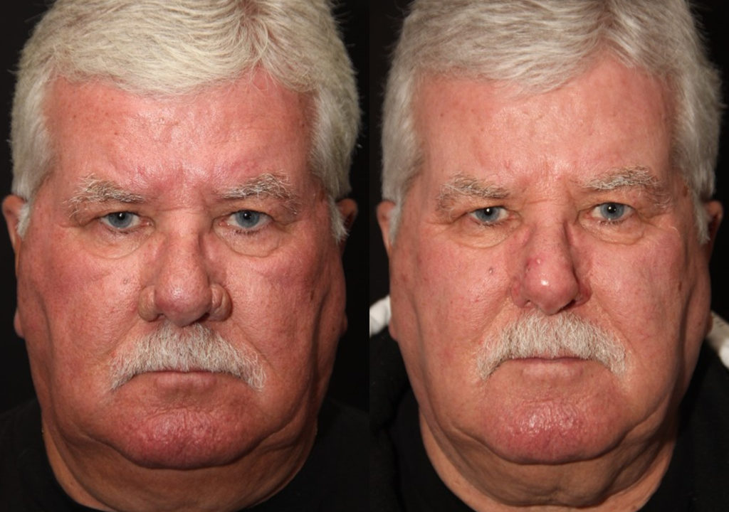 Rhinophyma before and after Toronto1