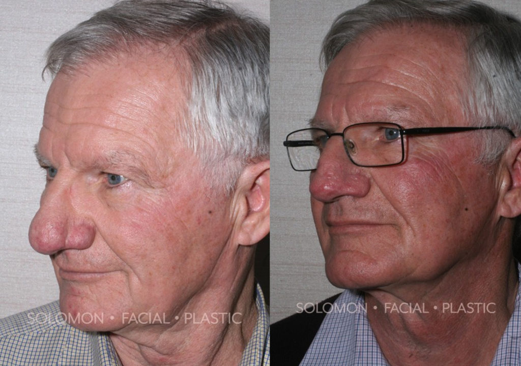 Rhinophyma before and after Toronto 2