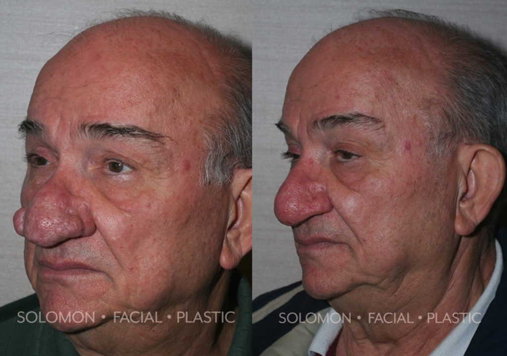 Rhinophyma before and after Toronto 3