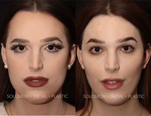 Brow Lift Before-After-3