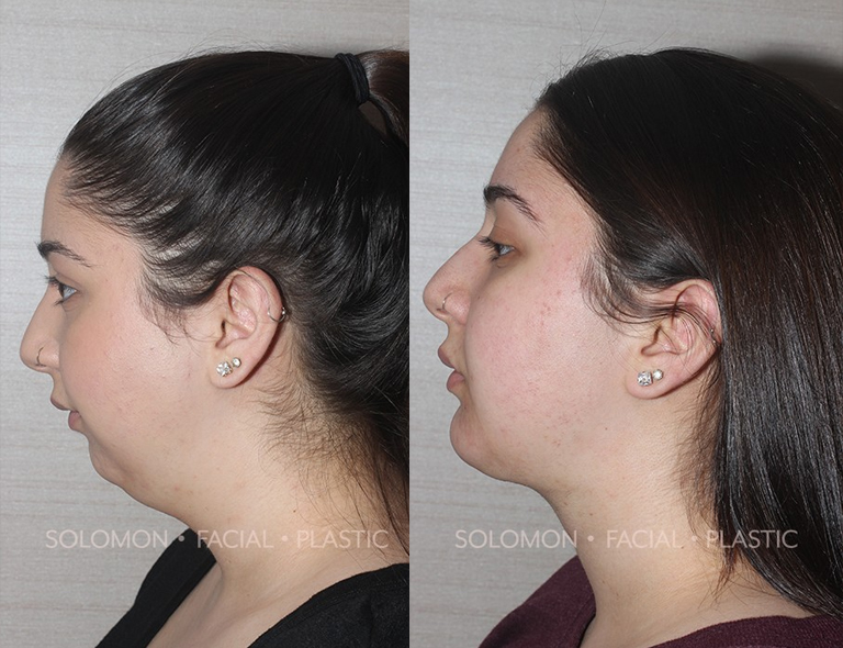 Chin implants before and after