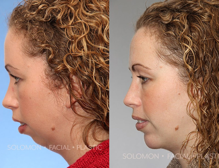 Chin reduction before and after