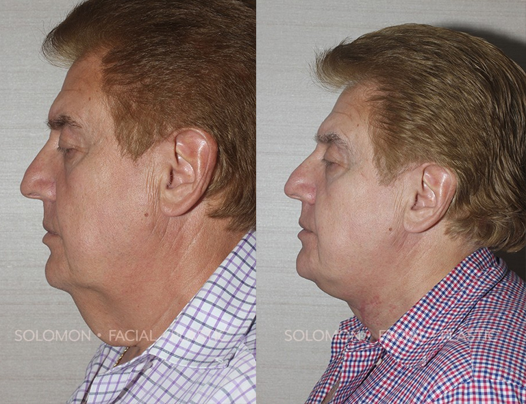 Neck Liposuction Before and After Patient 2