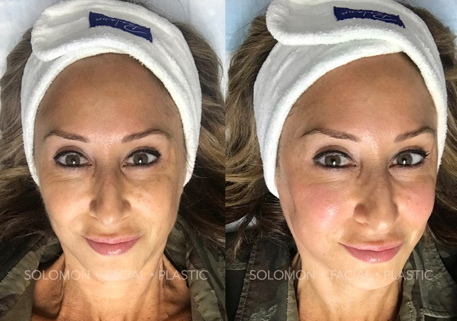 Forma Facial before and after Toronto 1