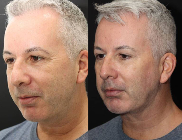 FaceTite before and after Toronto 1