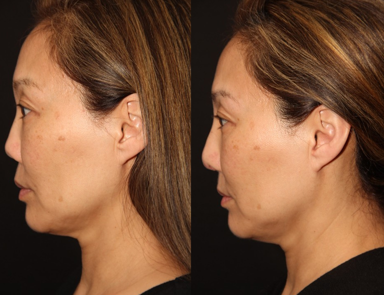 Before and After Asian Rhinoplasty