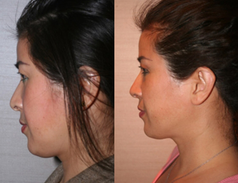 Before and After Asian Rhinoplasty 3