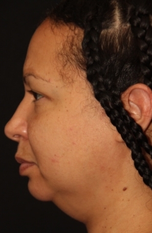 Facetite and Neck Liposuction Before and After Photos